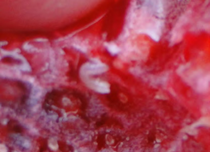 Close-up of inside of raspberry fruit. There is a small, squiggly, white larva curled up amongst the drupelets. 