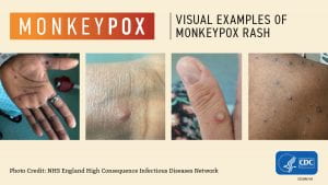 Four pictures of monkeypox lesions on the hands of patients.