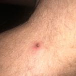 Blacklegged tick embedded behind knee