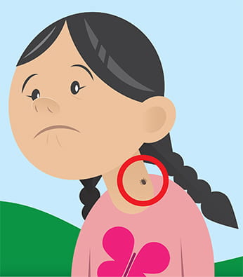 image of illustrated child with tick on skin